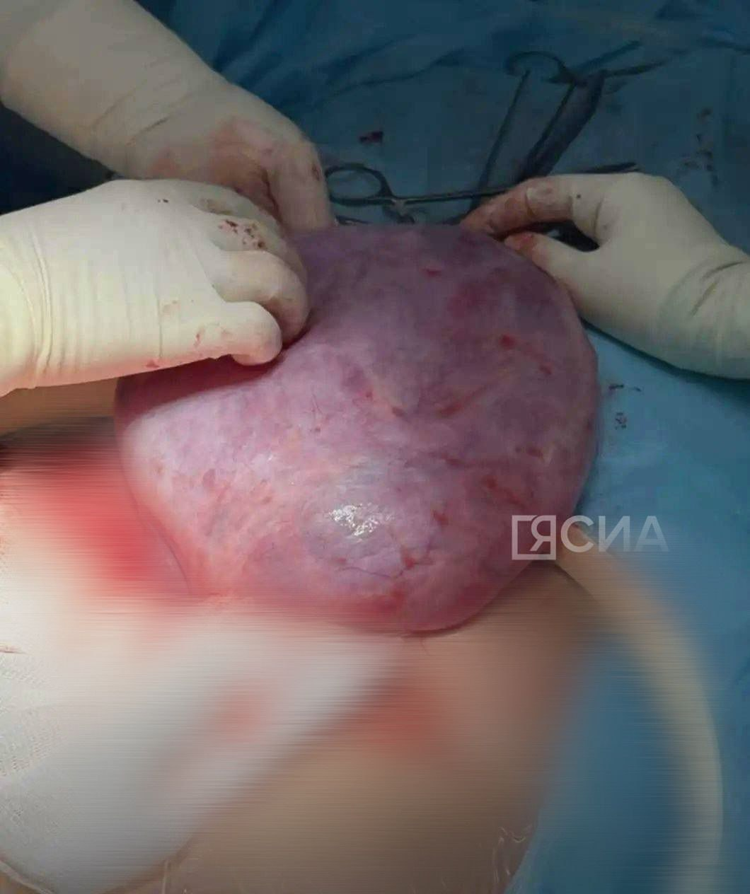 От боли до спасения: История 30-летней женщины с кистомой